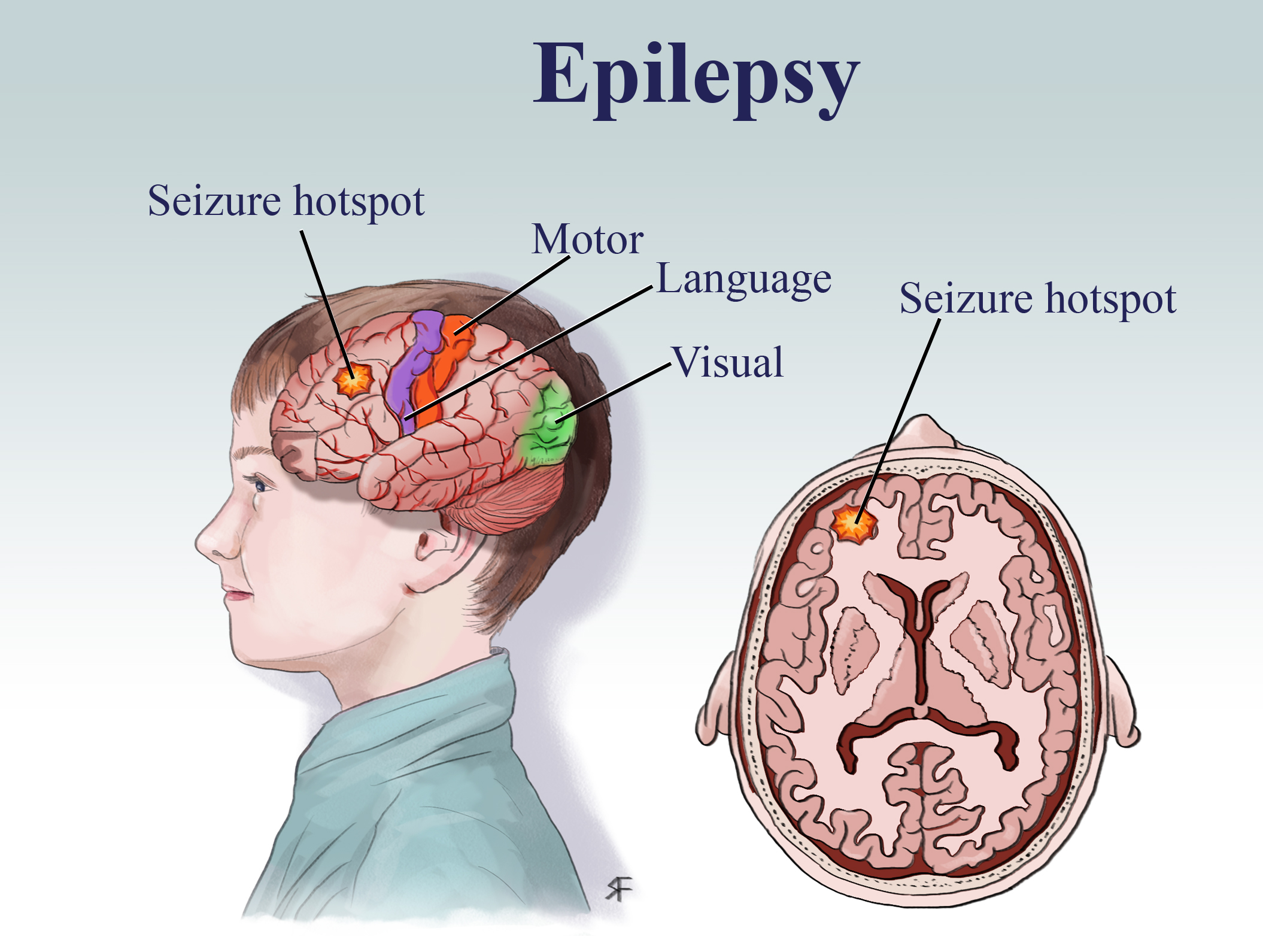 Epilepsy