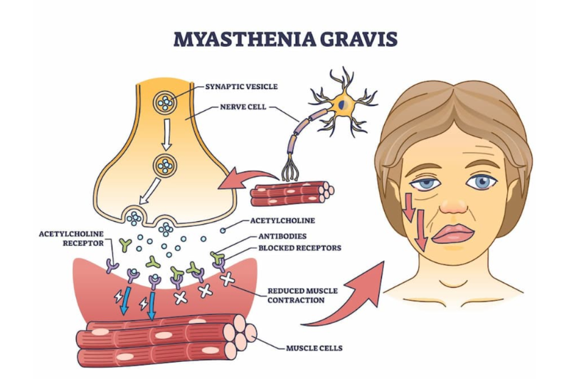 Myasthenia Gravis