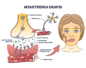 Myasthenia gravis
