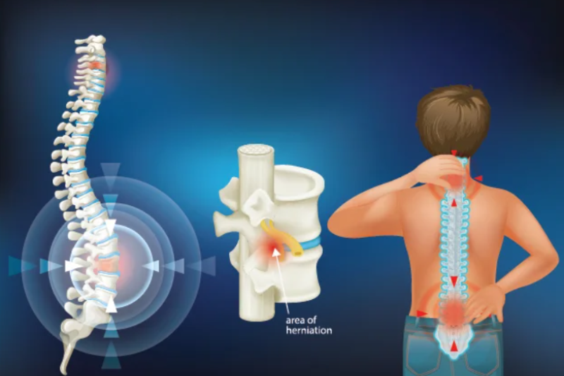Spinal Cord Disorders