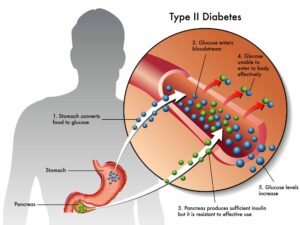 Type II Diabeties