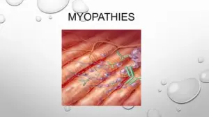 myopathy