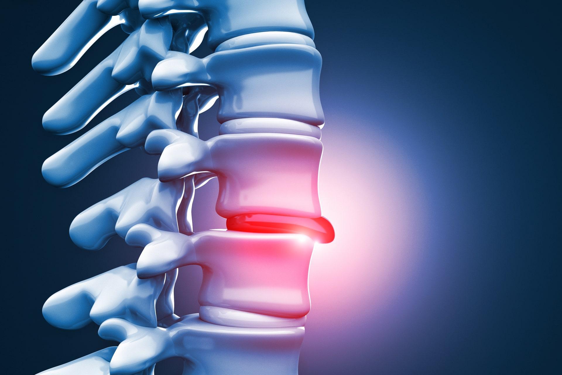 Herniated disc treatment