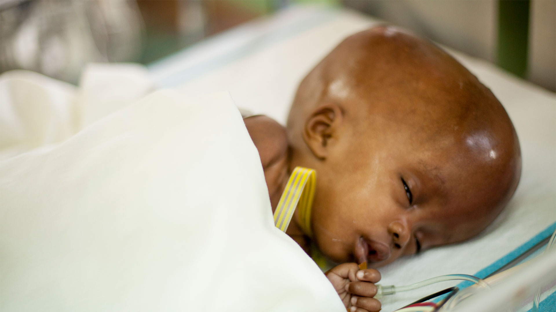 Hydrocephalus treatment in nagpur