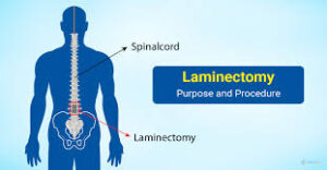 Laminectomy Surgery In Nagpur