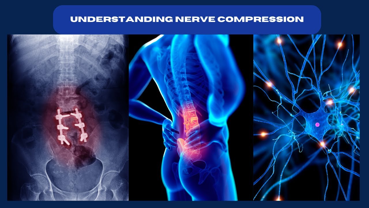 Nerve compression treatment