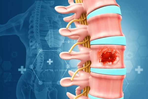 Spine tumor surgery